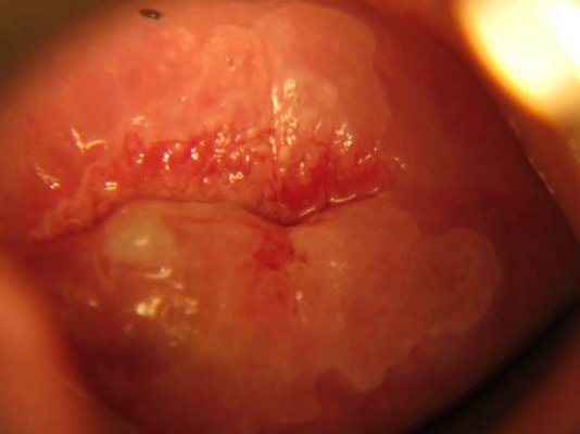 淋病的癥狀及圖片介紹，淋病的癥狀詳解與圖片介紹