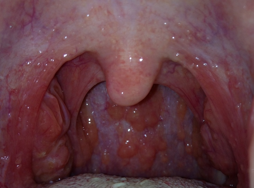 咽喉感覺有異物感但吞咽正常，原因、影響與處理方法，咽喉異物感解析，成因、影響及應(yīng)對(duì)之策