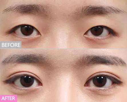 上海割雙眼皮最好的專(zhuān)家，專(zhuān)業(yè)團(tuán)隊(duì)與個(gè)性化設(shè)計(jì)的完美結(jié)合，上海雙眼皮手術(shù)專(zhuān)家團(tuán)隊(duì)，專(zhuān)業(yè)與個(gè)性化設(shè)計(jì)的完美融合