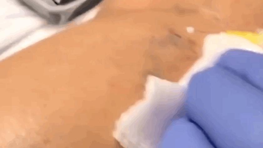 臉色紅血絲的根治方法，了解、預(yù)防與治療，臉色紅血絲的全方位解析，根治方法、預(yù)防與治療策略