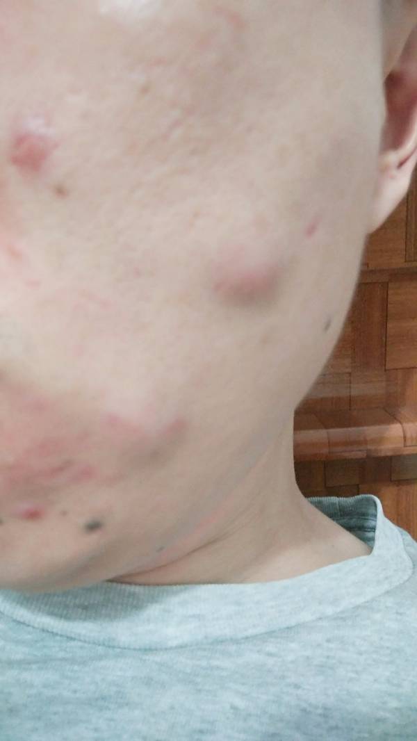 癤腫的硬包消除方法，全面解析與實用建議，癤腫硬包消除全攻略，實用方法與解析