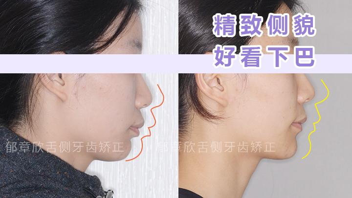 下巴后縮矯正方法詳解，下巴后縮矯正方法全面解析