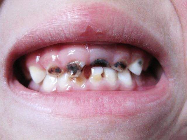初期蛀牙的樣子圖片，了解并預(yù)防牙齒的隱形威脅，初期蛀牙圖片展示，認(rèn)識(shí)并預(yù)防牙齒隱形威脅