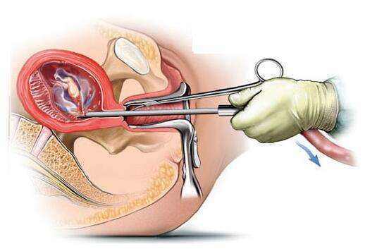 無痛人流術(shù)后醒來的疼痛感受解析，無痛人流術(shù)后醒來的疼痛感受解析及應(yīng)對(duì)建議