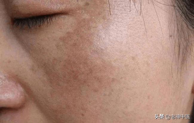 黃褐斑最怕一味中藥，深入解析與應(yīng)對策略，黃褐斑的克星，中藥深度解析與防治策略
