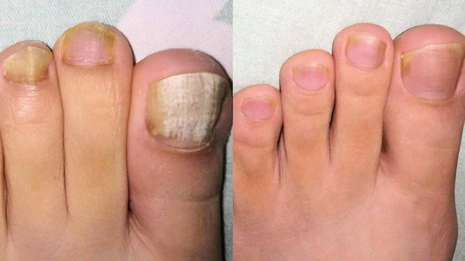 三天見效的灰指甲偏方，讓你輕松告別灰指困擾，三天見效的灰指甲偏方，告別灰指煩惱