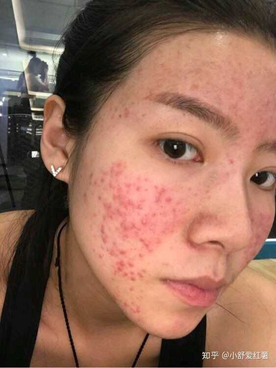 如何有效去除臉上的痘印——全方位指南，全方位指南，如何有效去除臉上痘印的方法