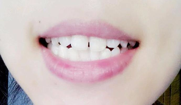 自然縮小門牙縫的方法，有效且實用的建議，自然縮小門牙縫的有效實用方法