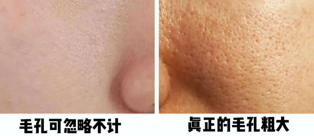 怎樣毛孔可以慢慢縮小，護膚秘籍與實用建議，護膚秘籍，縮小毛孔實用建議與指南