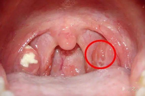 扁桃體炎化膿最快治愈法，全面解析與應(yīng)對策略，扁桃體炎化膿的最快治愈法，全面解析及應(yīng)對攻略