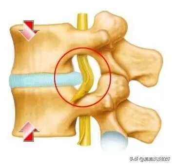 腰椎間盤(pán)突出怎么治療斷根，全面解析最佳方案，腰椎間盤(pán)突出最佳治療斷根方案解析