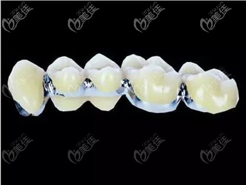 鈷鉻烤瓷牙價格解析，多少錢一顆？，鈷鉻烤瓷牙價格詳解，每顆費用是多少？