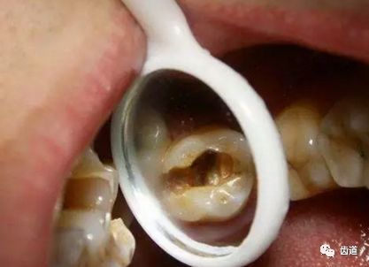 如何判斷牙齒牙洞已經(jīng)深入到牙髓？，牙齒牙洞深度判斷，如何確定已影響牙髓？