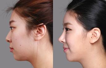 耳軟骨隆鼻的危害有哪些，深入了解與防范，耳軟骨隆鼻的危害解析，深入了解及防范措施