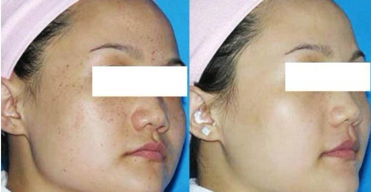 激光祛斑后需要注意的五大事項，激光祛斑后的五大注意事項詳解