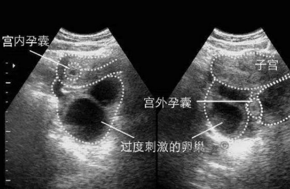 宮外孕打掉最佳時(shí)間，了解宮外孕及其處理時(shí)機(jī)的重要性，宮外孕處理最佳時(shí)間解析，了解宮外孕及其處理的重要性