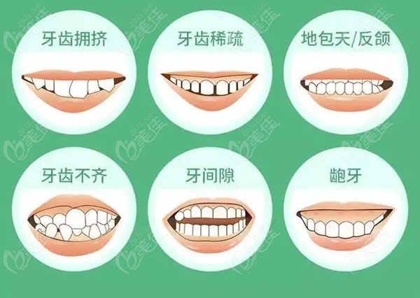 牙齒正畸費用詳解，一般多少？，牙齒正畸費用全面解析，了解一般價格及影響因素