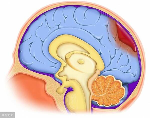 腦出血后遺癥有哪些，腦出血后遺癥的類型與表現