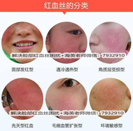 臉上出現(xiàn)紅血絲怎么治療，全面解析有效方法，臉上紅血絲全面解析與有效治療方法