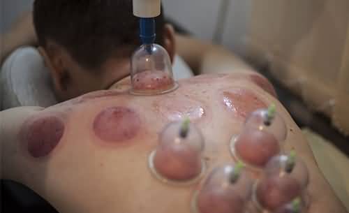 拔罐治療需謹(jǐn)慎，了解拔罐20天死亡的風(fēng)險與正確方法，拔罐治療風(fēng)險警示，了解正確方法與避免20天死亡風(fēng)險