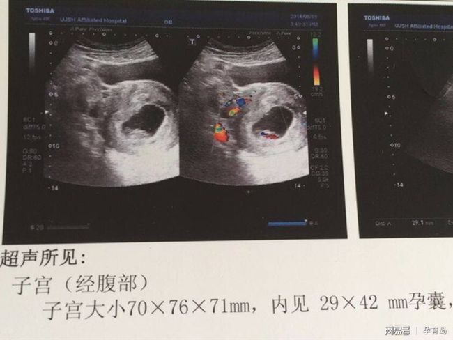 有卵黃囊基本就穩(wěn)了，早期妊娠的穩(wěn)固跡象與注意事項，早期妊娠的穩(wěn)固跡象，卵黃囊出現(xiàn)后的穩(wěn)定與注意事項