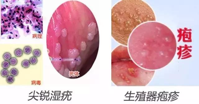 男性尖銳濕疣初期圖片及其相關(guān)解析，男性尖銳濕疣初期圖片及癥狀解析