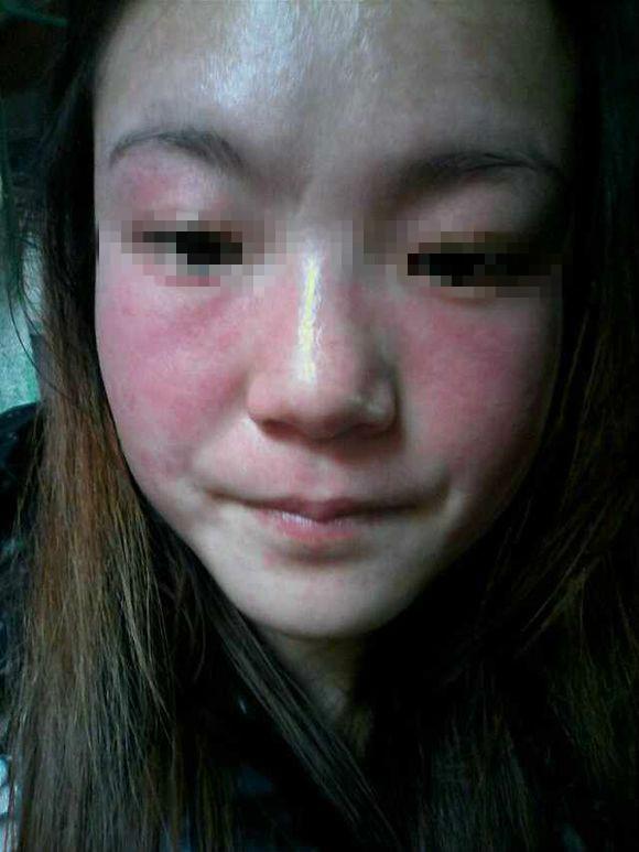 如何去掉黃褐斑的最好辦法，如何有效去除黃褐斑的方法探究