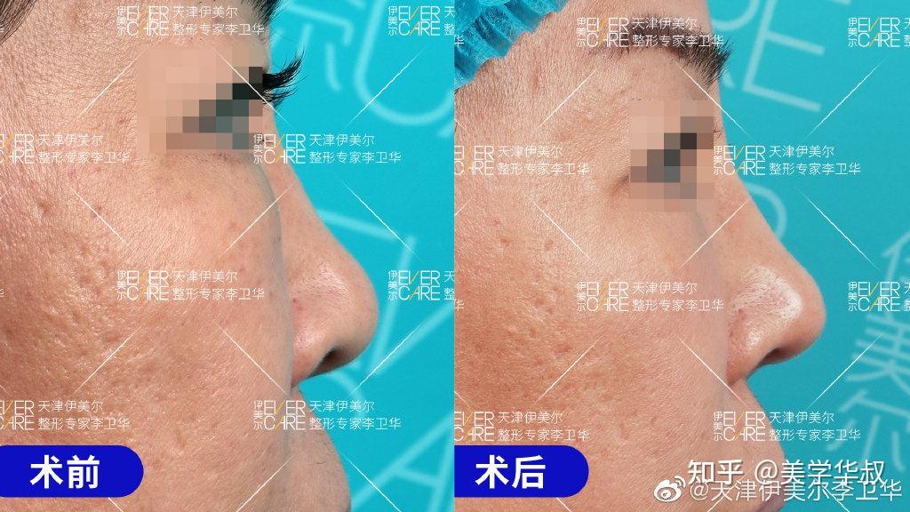 捏鼻三年，鼻頭變大——深度解析捏鼻子對(duì)鼻子的影響及應(yīng)對(duì)之策，捏鼻三年的影響，鼻頭變大原因解析與應(yīng)對(duì)之策