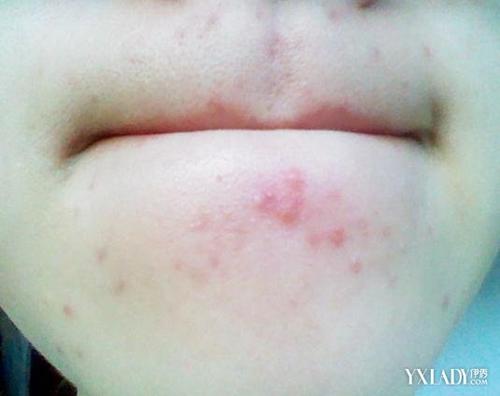 下巴周圍反復(fù)長痘痘的原因及解決方法，下巴周圍反復(fù)長痘成因與解決策略