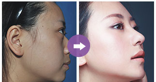 關(guān)于只做鼻翼縮小手術(shù)的費(fèi)用分析，只做鼻翼縮小手術(shù)的費(fèi)用詳解