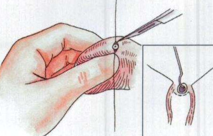 結(jié)扎手術(shù)后能否恢復(fù)生育能力，解析可能性與關(guān)鍵因素，結(jié)扎手術(shù)后恢復(fù)生育能力的可能性與關(guān)鍵因素解析