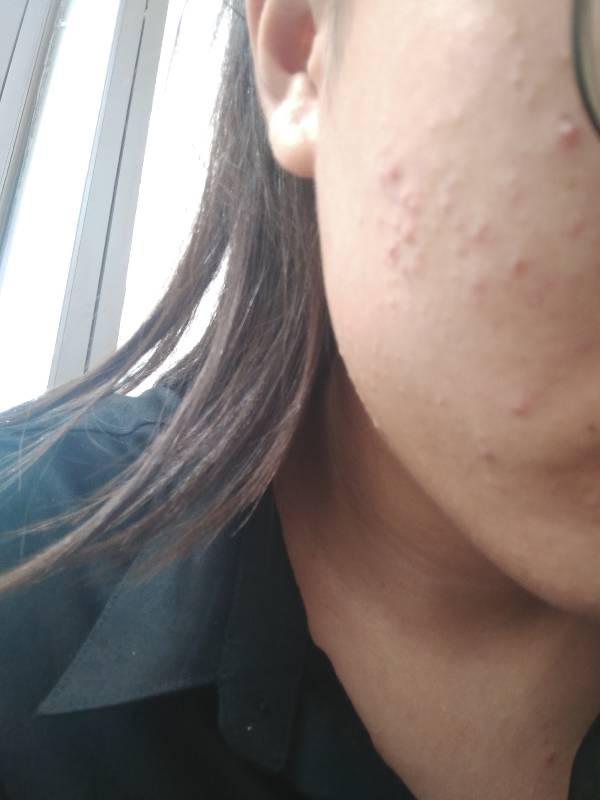 閉口粉刺的樣子與圖片解析，閉口粉刺詳解，圖片解析及其外觀特征