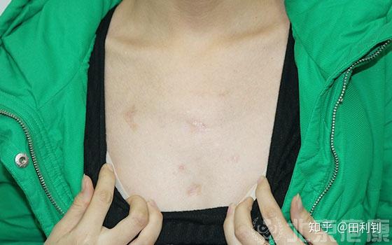 疤痕疙瘩，成因、治療與預(yù)防，疤痕疙瘩，成因解析、治療選擇與預(yù)防策略