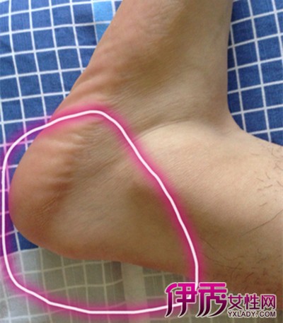 腳后跟疼的原因及治療方法，全面解析與應(yīng)對之道，腳后跟疼痛解析，成因、治療方法與應(yīng)對之道