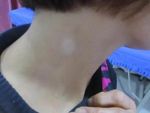 皮膚上有白斑是什么原因，深度解析白斑成因與應(yīng)對(duì)之策，皮膚白斑成因深度解析及應(yīng)對(duì)之策，白斑成因與治療方法探討