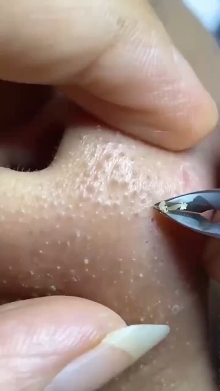 如何有效處理黑頭問題——全方位解析黑頭成因與解決方案，全方位解析，黑頭成因探究與有效處理方案