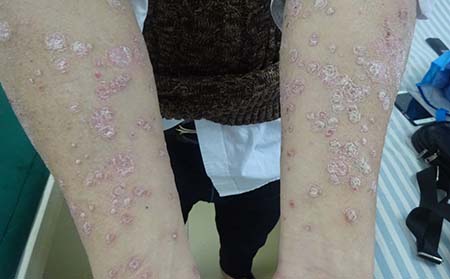 銀屑病為何被稱為窮病——深度解析，銀屑病為何被稱為‘窮病’？——深度探究其背后原因