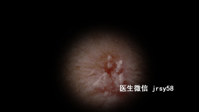 尖銳濕疹，深入了解與治療建議，尖銳濕疹，深度解析與治療指南