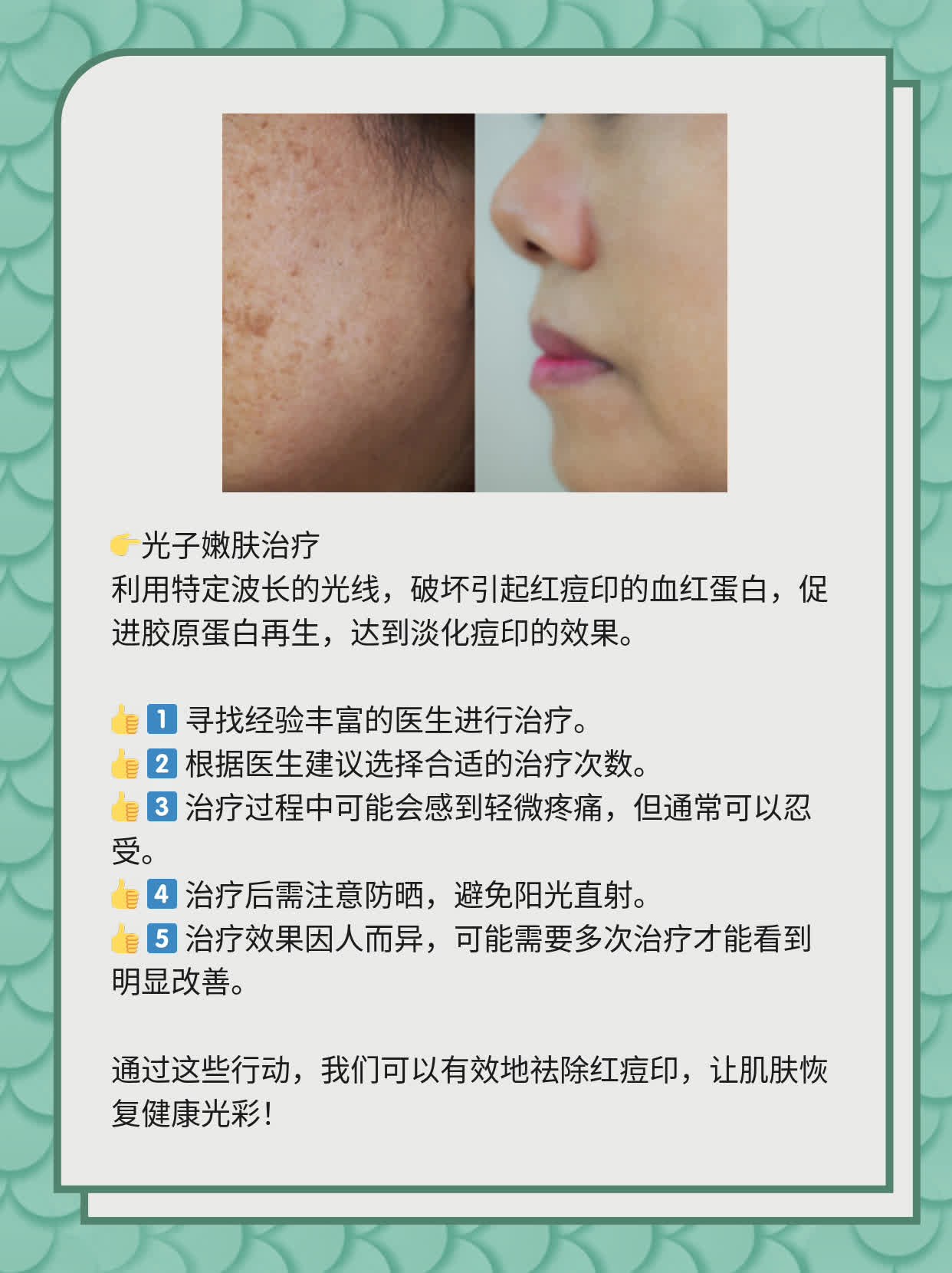 如何有效去除紅痘印，一站式解決方案，一站式解決紅痘印問題，有效去除方法大全