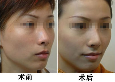 光子嫩膚做一次有效嗎？深入了解光子嫩膚的效果與過程，光子嫩膚效果與過程解析，做一次是否有效？