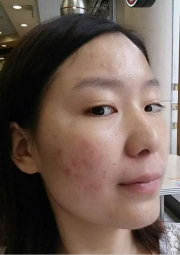 如何有效去除臉上痘痘——多種方法助您重拾肌膚光彩，多種方法助您有效去除臉部痘痘，重拾肌膚光彩