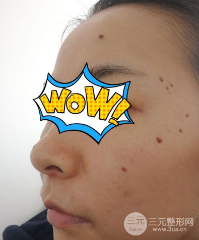 祛痣后十天恢復(fù)圖片，了解恢復(fù)過程，促進(jìn)健康愈合，祛痣后十天恢復(fù)過程圖片展示，了解愈合進(jìn)展，助力健康恢復(fù)