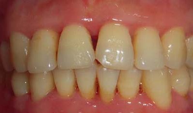 全面解析牙周炎，預(yù)防、診斷與治療，全面解析牙周炎，預(yù)防、診斷與治療方法指南