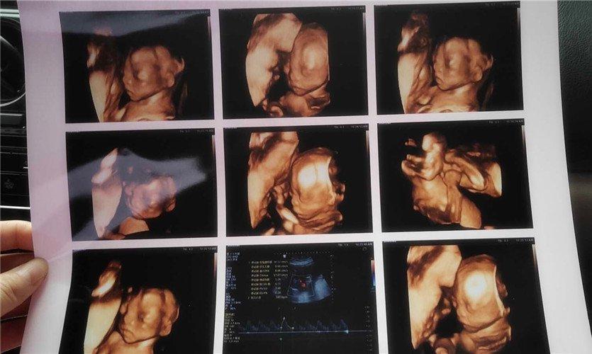 四維彩超下的胎兒蛋蛋，探索早期胎兒生殖器官的發(fā)育之旅，四維彩超下的胎兒蛋蛋，揭秘早期胎兒生殖器官發(fā)育之旅