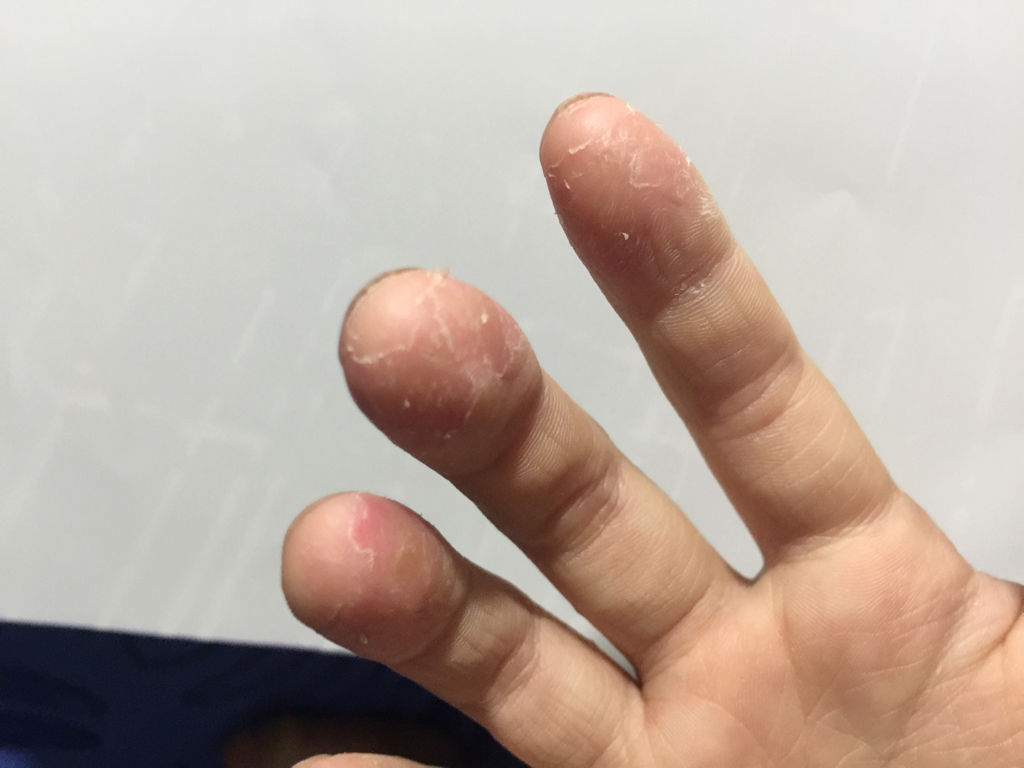 手指脫皮是什么原因，深度解析與應對建議，手指脫皮深度解析，成因、應對與建議