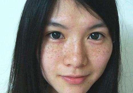 雀斑激光打幾次能干凈？全面解析激光治療雀斑，全面解析激光治療雀斑，次數(shù)與效果探討