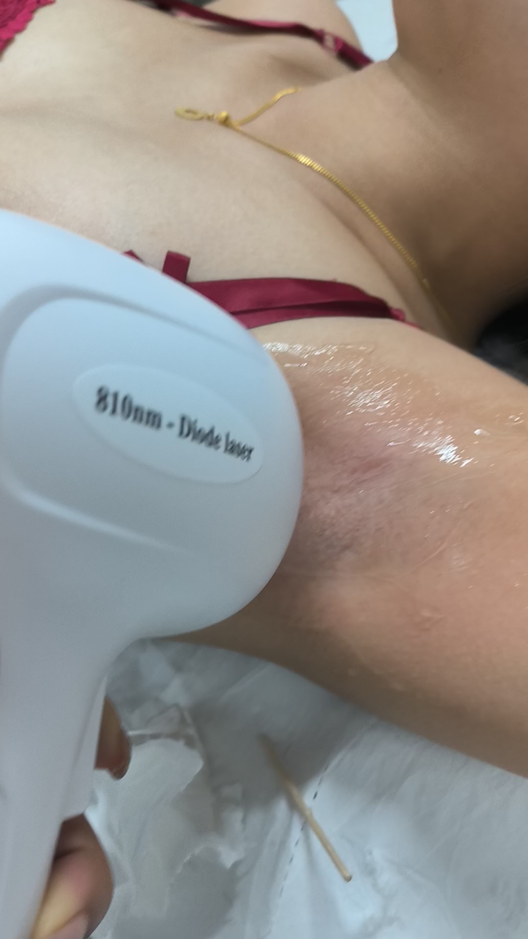 冰點(diǎn)脫毛圖片效果圖，展現(xiàn)美麗的新選擇，冰點(diǎn)脫毛效果圖展示，美麗新選擇之旅