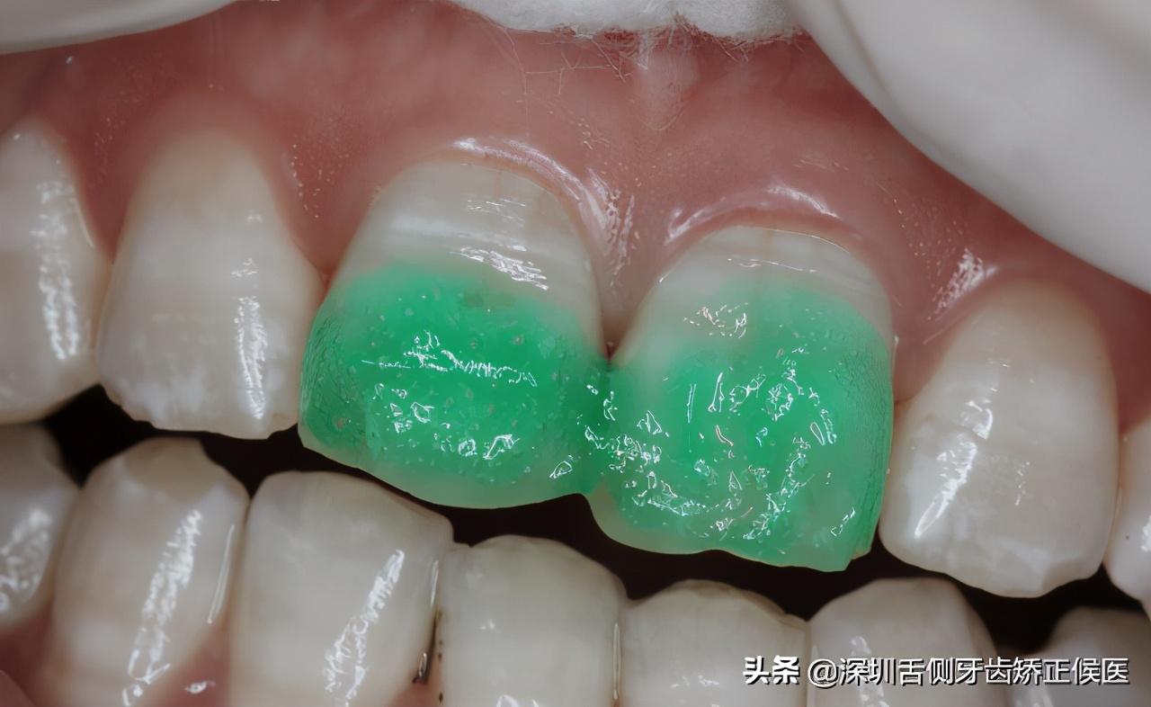 牙齒貼面的好處與壞處，全面解析牙齒美容新選擇，牙齒貼面的優(yōu)缺點(diǎn)解析，牙齒美容的新選擇探討