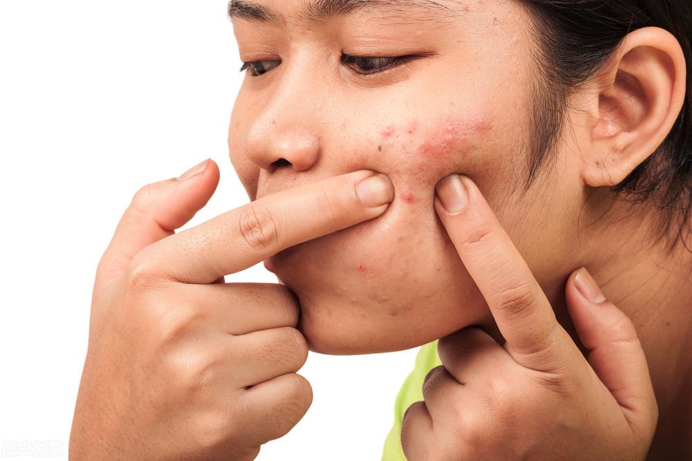 全面解析，痤瘡怎么治才能好？，全面解析，痤瘡治療的有效方法與策略