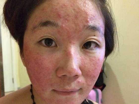 激素臉的特征與圖片解析，激素臉特征詳解及圖片解析